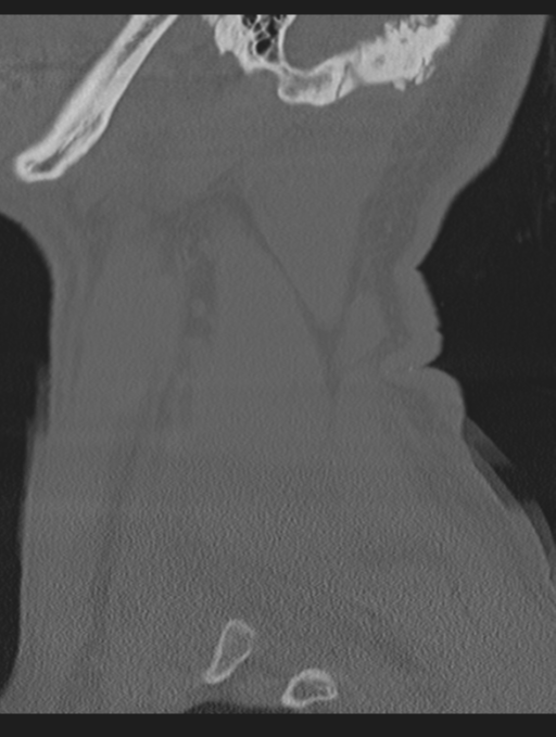 Cavernoma of cervical cord (Radiopaedia 50838-56346 Sagittal bone window 72).png