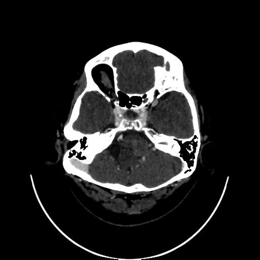 Cavernoma with developmental venous anomaly (Radiopaedia 22470-22506 C 25).jpg