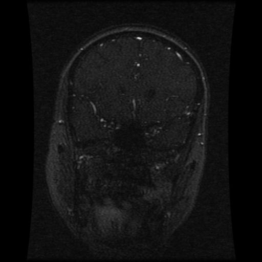 Cavernoma with developmental venous anomaly (Radiopaedia 22470-22507 MRV 90).jpg