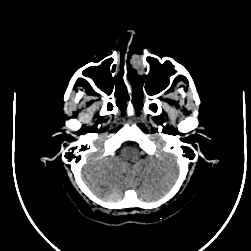 Cavernous hemangioma of the cerebellar falx (Radiopaedia 73025-83723 Axial non-contrast 19).jpg