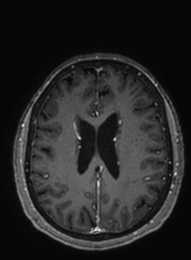 Cavernous hemangioma of the cerebellar falx (Radiopaedia 73025-83724 Axial T1 C+ 119).jpg