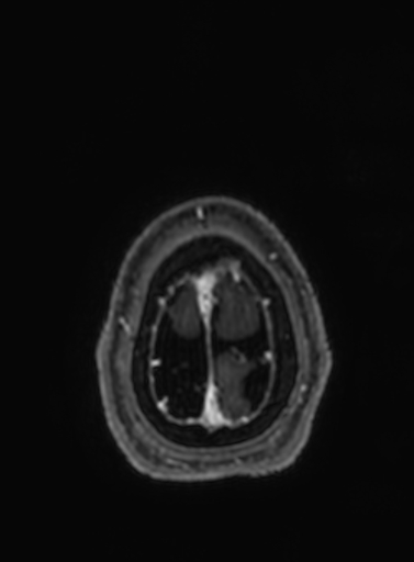 Cavernous hemangioma of the cerebellar falx (Radiopaedia 73025-83724 Axial T1 C+ 27).jpg