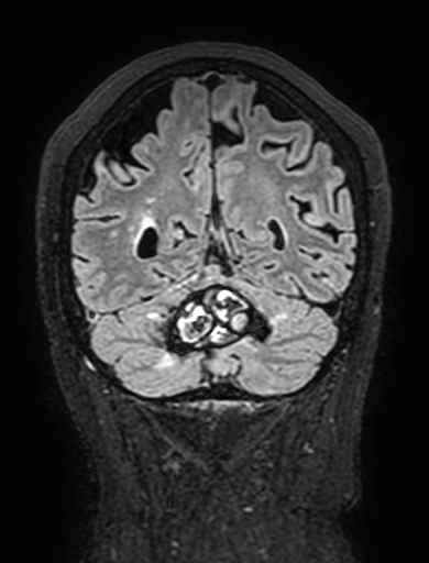 Cavernous hemangioma of the cerebellar falx (Radiopaedia 73025-83724 Coronal FLAIR 268).jpg