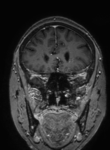 Cavernous hemangioma of the cerebellar falx (Radiopaedia 73025-83724 Coronal T1 C+ 112).jpg