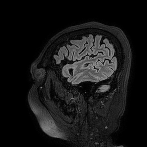 Cavernous hemangioma of the cerebellar falx (Radiopaedia 73025-83724 Sagittal FLAIR 22).jpg