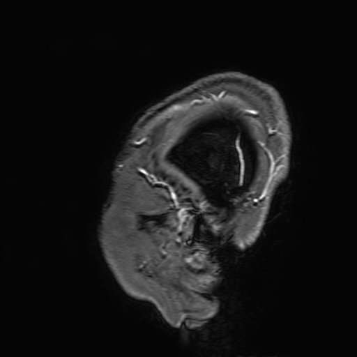 File:Cavernous hemangioma of the cerebellar falx (Radiopaedia 73025-83724 Sagittal T1 C+ 9).jpg