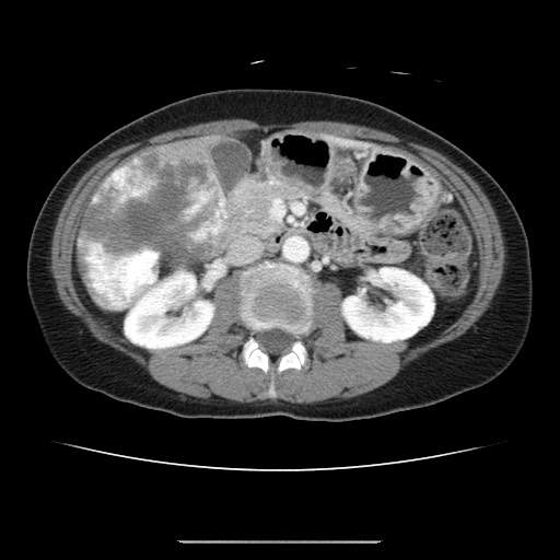Cavernous hepatic hemangioma (Radiopaedia 75441-86667 B 49).jpg