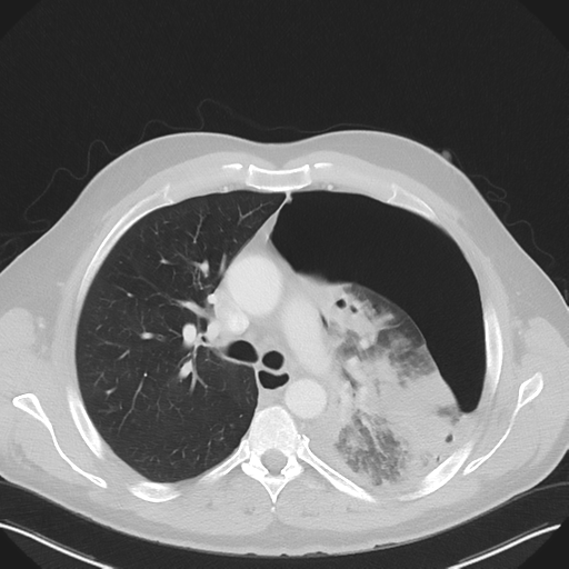 File:Cavitating pneumonia complicated by pneumothorax (Radiopaedia 48149-52994 Axial lung window 27).png