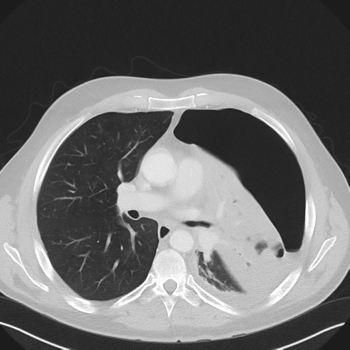 Cavitating pneumonia complicated by pneumothorax (Radiopaedia 48149-52994 Axial lung window 33).png