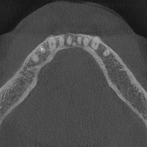 Cemento-osseous dysplasia (Radiopaedia 48251-53126 Axial non-contrast 26).jpg