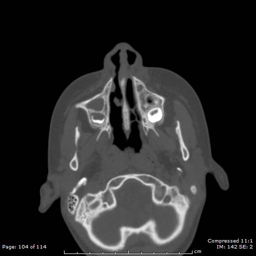 File:Central giant cell granuloma (Radiopaedia 45612-49754 Axial bone window 52).jpg