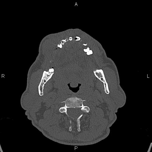 File:Central giant cell granuloma (Radiopaedia 83346-97761 Axial bone window 6).jpg