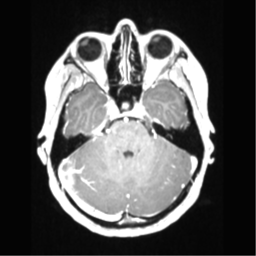 File:Central neurocytoma (Radiopaedia 37664-39557 Axial T1 C+ 25).png