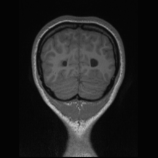 Central neurocytoma (Radiopaedia 37664-39557 Coronal T1 14).png