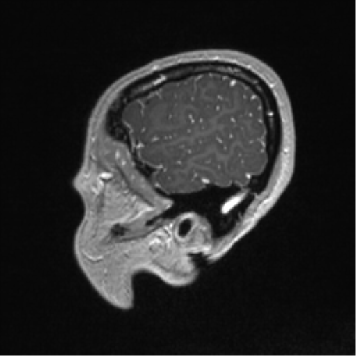 File:Central neurocytoma (Radiopaedia 37664-39557 Sagittal T1 C+ 83).png