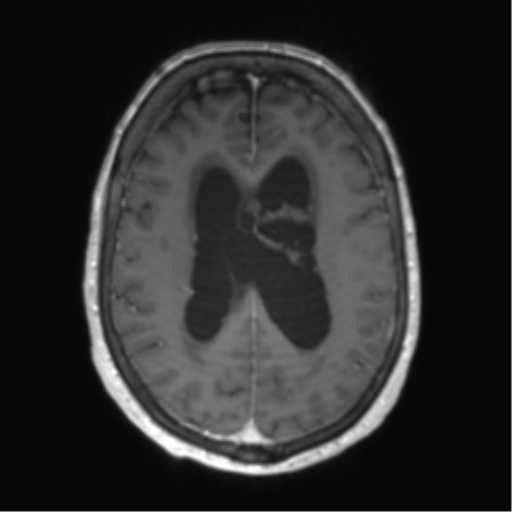 Central neurocytoma (Radiopaedia 65317-74345 Axial T1 C+ 37).png