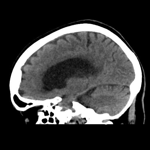 File:Central neurocytoma (Radiopaedia 65317-74346 C 23).png