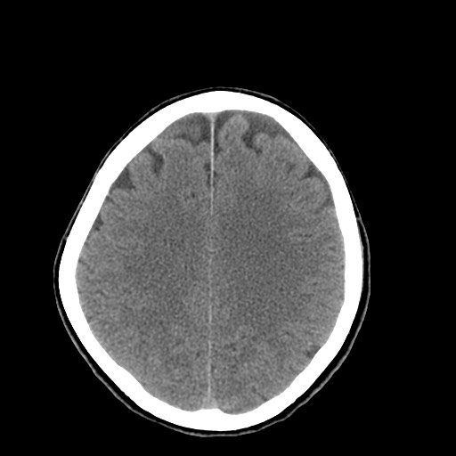 Central neurocytoma (Radiopaedia 68725-78432 Axial non-contrast 37).jpg