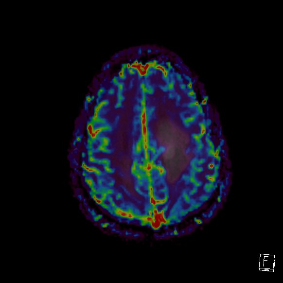 Central neurocytoma (Radiopaedia 84497-99872 Axial Perfusion 70).jpg