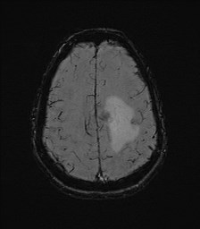 Central neurocytoma (Radiopaedia 84497-99872 Axial SWI 55).jpg