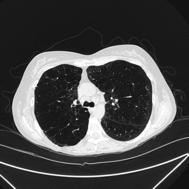 Centrilobular pulmonary emphysema (Radiopaedia 24495-24789 Axial lung window 36).jpg