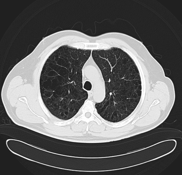Centrilobular pulmonary emphysema (Radiopaedia 26808-26971 C 13).jpg