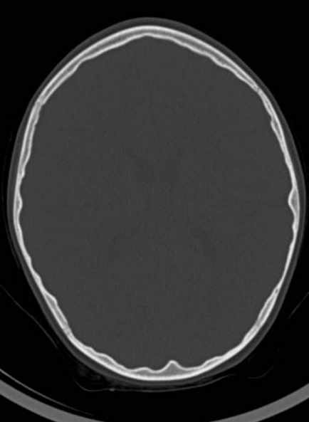 File:Cerebellar abscess (Radiopaedia 73727-84527 Axial bone window 42).jpg