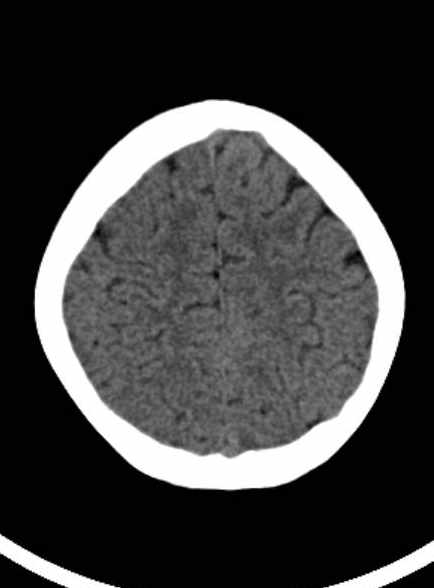 Cerebellar abscess (Radiopaedia 73727-84527 Axial non-contrast 54).jpg