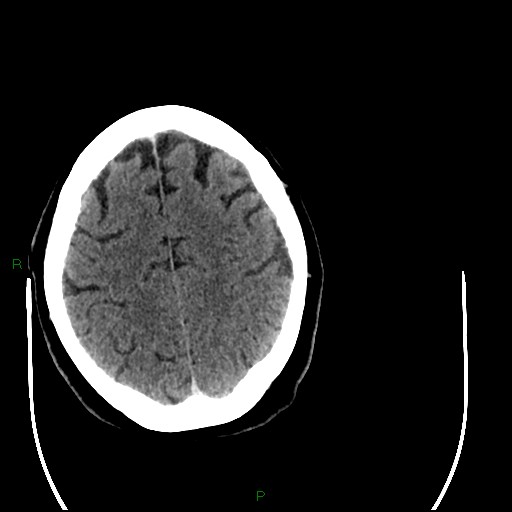 Cerebellar abscess (Radiopaedia 78135-90671 Axial C+ delayed 84).jpg