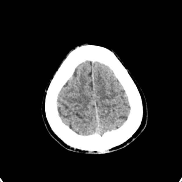Cerebellar abscess secondary to mastoiditis (Radiopaedia 26284-26412 Axial non-contrast 140).jpg