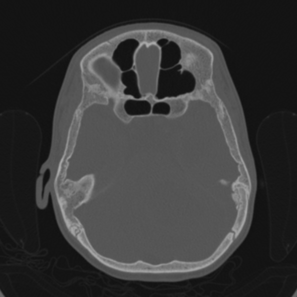 Cerebellar abscess secondary to mastoiditis (Radiopaedia 26284-26413 Axial bone window 76).jpg