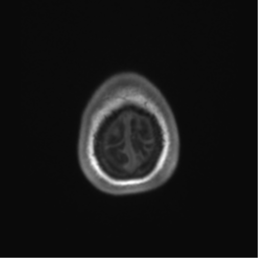 File:Cerebellar agenesis with hypoplastic pons (pontocerebellar hypoplasia) (Radiopaedia 57224-64138 Axial T1 73).png
