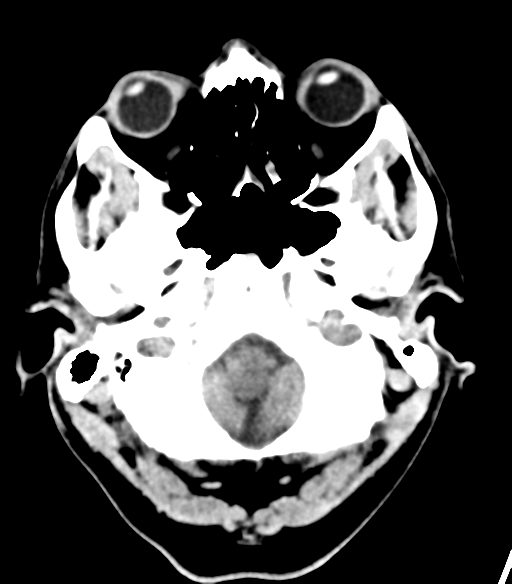 File:Cerebellar hemorrhage (Radiopaedia 37000-38669 Axial non-contrast 7).png