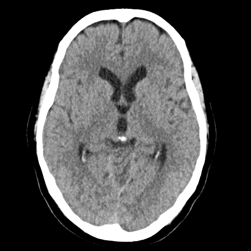 Cerebellar metastasis (Radiopaedia 54578-60812 Axial non-contrast 23).png