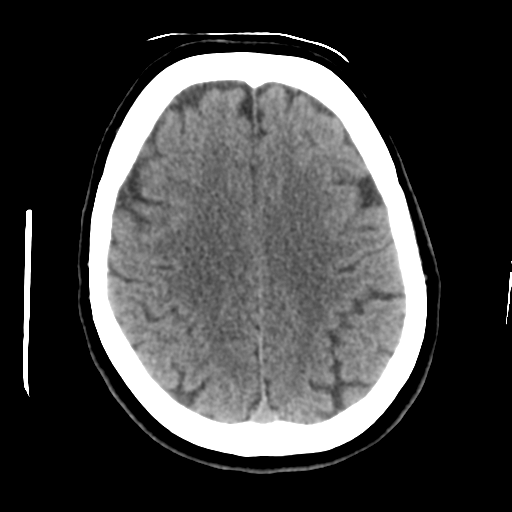 Cerebellar metastasis (cystic appearance) (Radiopaedia 41395-44258 Axial non-contrast 38).png