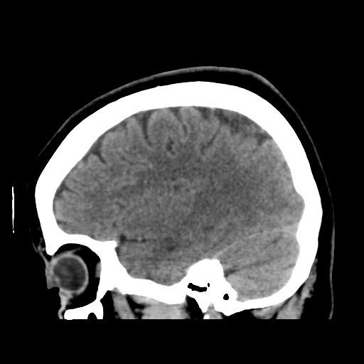 File:Cerebellar metastasis (cystic appearance) (Radiopaedia 41395-44258 E 18).png