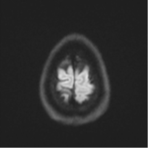 Cerebellar metastasis - adenocarcinoma lung (Radiopaedia 63184-71715 Axial DWI 56).png