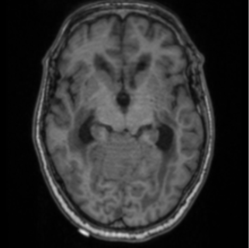 Cerebellar metastasis from lung adenocarcinoma (Radiopaedia 86690-102829 Axial T1 37).png