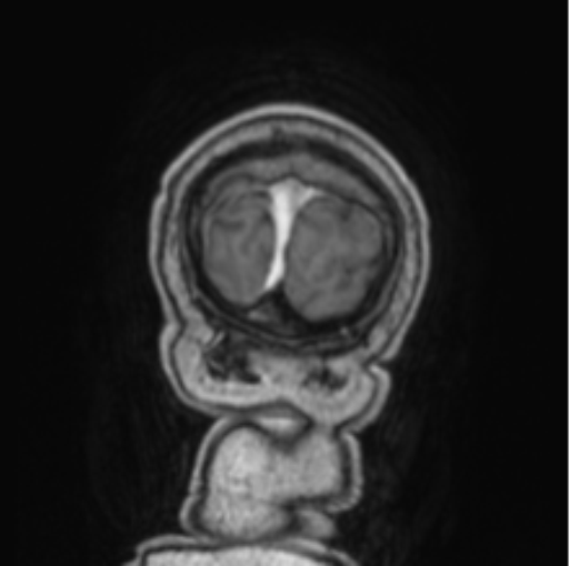 Cerebellar metastasis from lung adenocarcinoma (Radiopaedia 86690-102829 Coronal T1 C+ 6).png