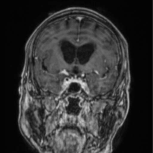 Cerebellar metastasis from lung adenocarcinoma (Radiopaedia 86690-102829 Coronal T1 C+ 61).png