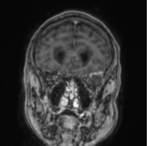 File:Cerebellar metastasis from lung adenocarcinoma (Radiopaedia 86690-102829 Coronal T1 C+ 74).png