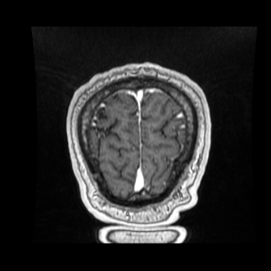File:Cerebellar metastasis of pulmonary adenocarcinoma, cavernous venous malformation, and developmental venous anomaly (Radiopaedia 85827-101661 Coronal T1 C+ 18).jpg