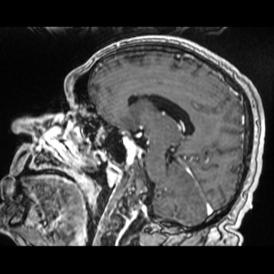 Cerebellar metastasis of pulmonary adenocarcinoma, cavernous venous malformation, and developmental venous anomaly (Radiopaedia 85827-101661 Sagittal T1 C+ 56).jpg