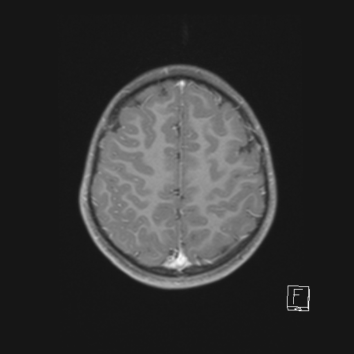 File:Cerebellar stroke (Radiopaedia 32202-33150 Axial T1 C+ 55).png