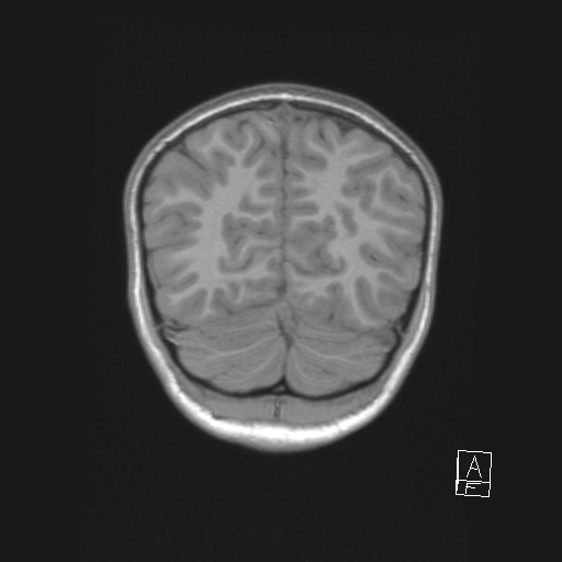 Cerebellar stroke (Radiopaedia 32202-33150 Coronal T1 50).png