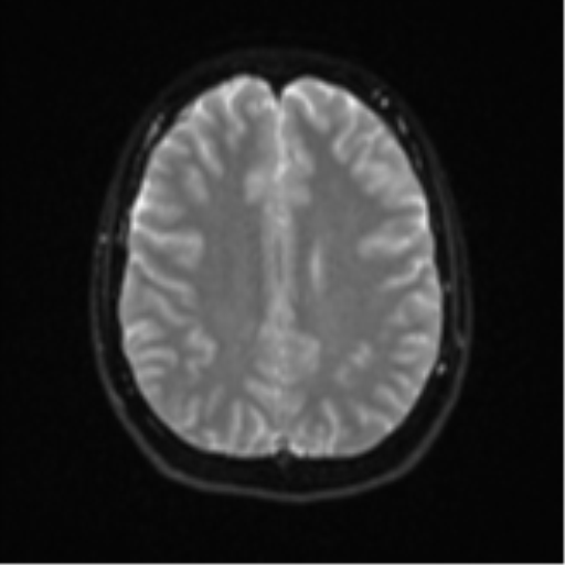 Cerebellar tuberculomas (Radiopaedia 46939-51472 Axial DWI 20).png