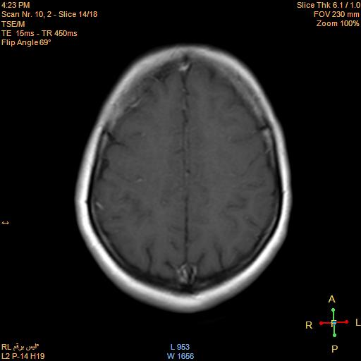 File:Cerebellopontine angle meningioma (Radiopaedia 22488-22525 Axial T1 C+ 13).jpg