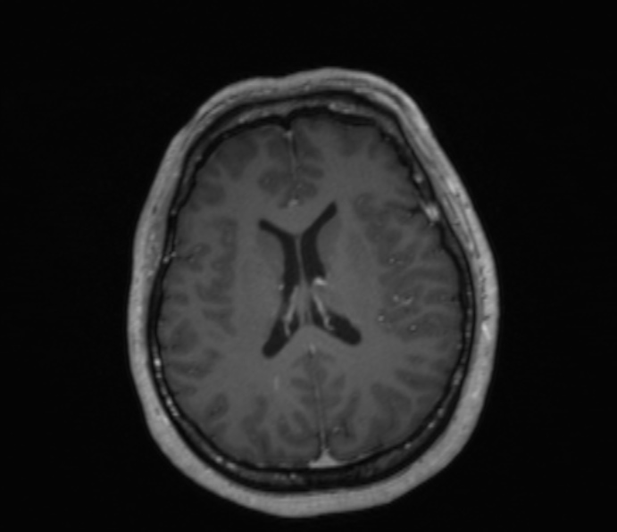 Cerebellopontine angle meningioma (Radiopaedia 35181-36715 Axial T1 C+ 24).jpg