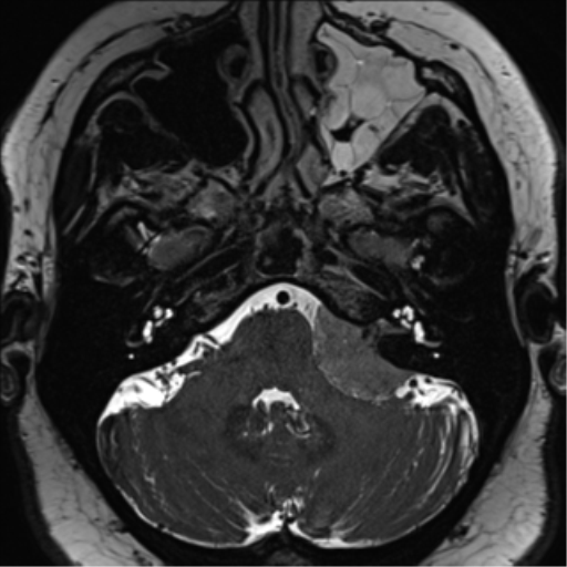 Cerebellopontine angle meningioma (Radiopaedia 48434-53348 Axial T2 Space 50).png