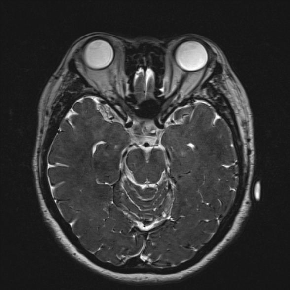 File:Cerebellopontine angle meningioma (Radiopaedia 53561-59591 Axial 3D volume T2 93).jpg